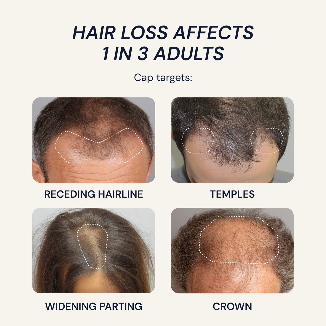 hair loss affects 1 in 3 adults