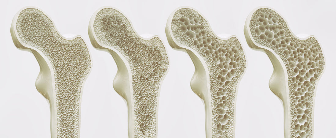Difference in bone density - how it looks like.